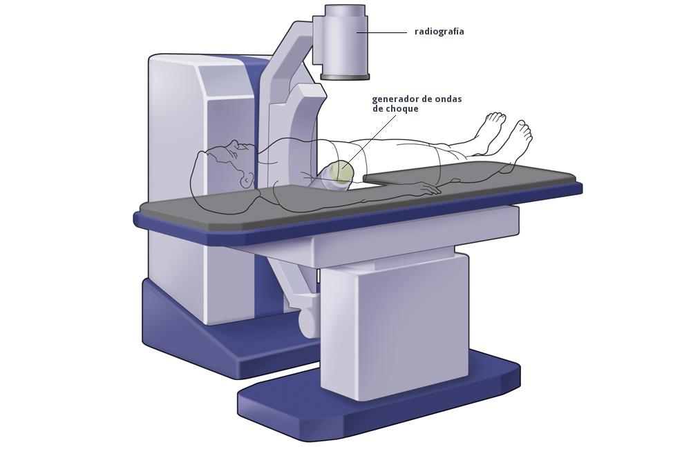 máquina-de-litotricia-extracorpórea-por-ondas-de-choque