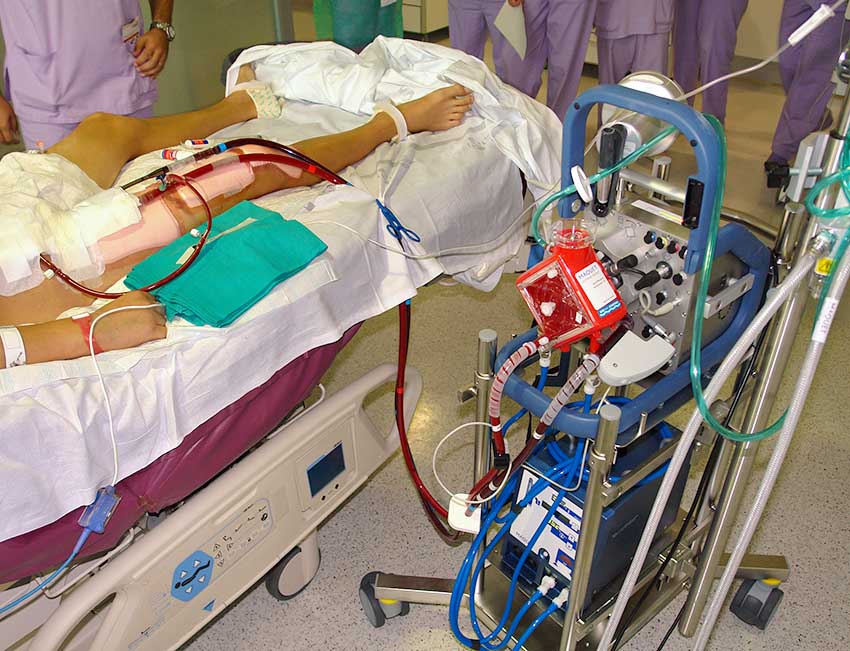 Paciente con sistema ECMO